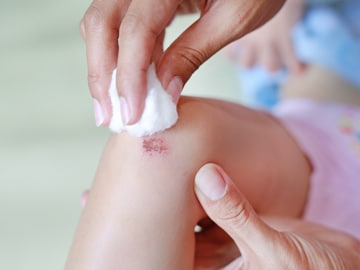Understanding minor wound￼ | Zambuk